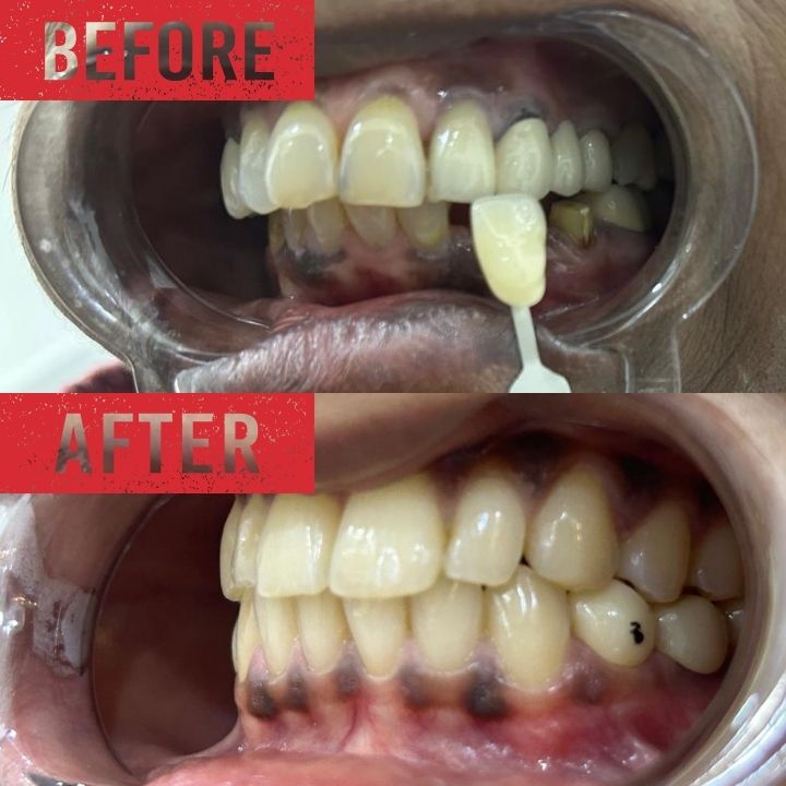 dental implants at poorva HBR layout