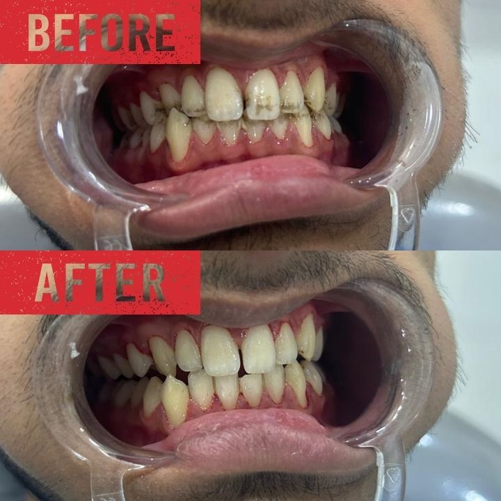 Dentist performing plaque removal and teeth cleaning