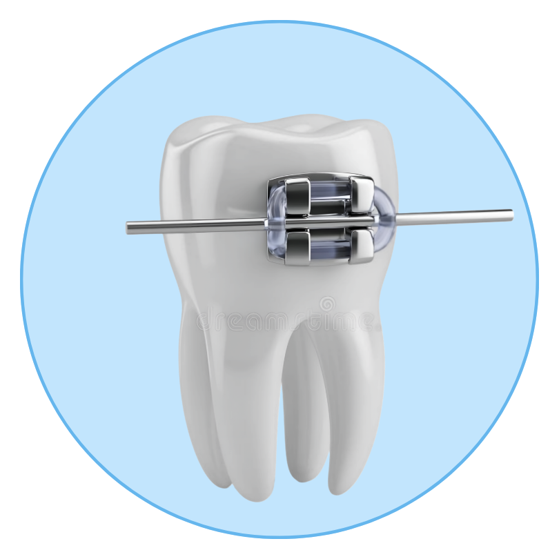 Metal Braces