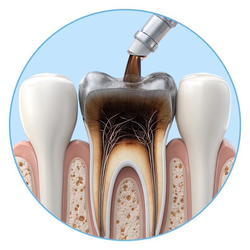 Root Canal
